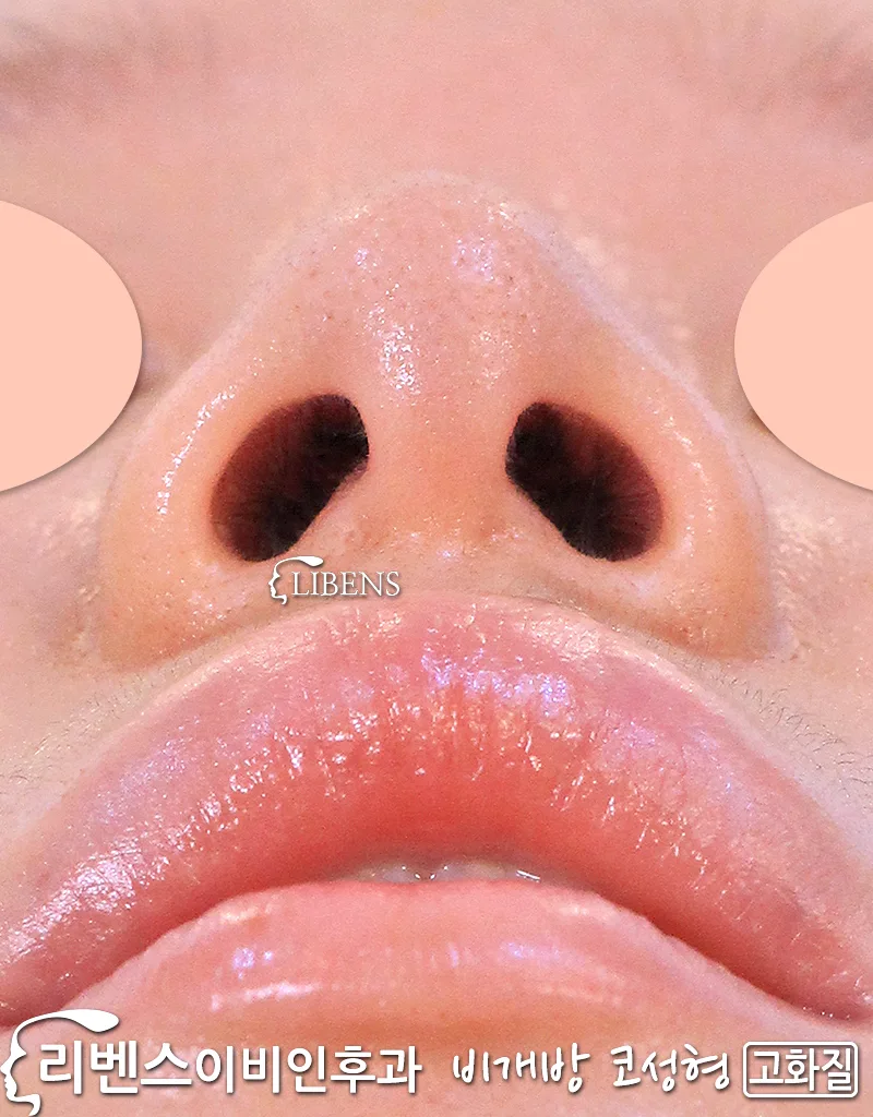 무보형물 매부리코 성형 메부리코 깍기 교정 수술 내측 외측 코뼈 절골 여자 코끝 높이기 성형 s1151