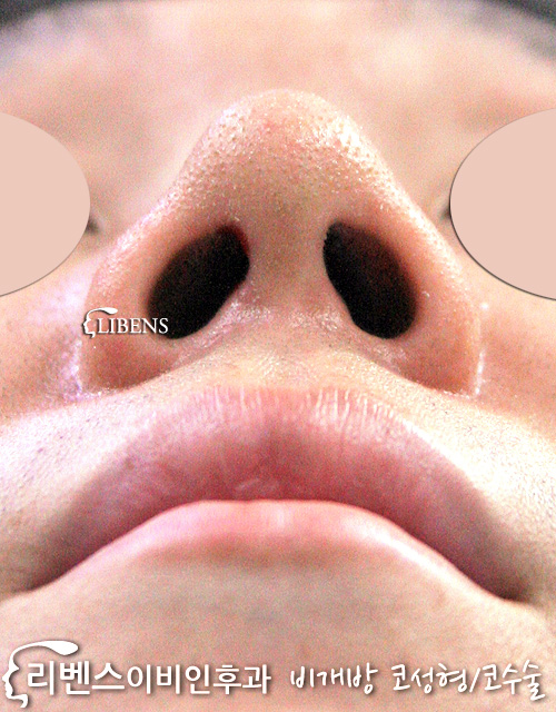 콧대 코끝 수술 실리콘 매부리코 비중격 연골 남자 성형 s132
