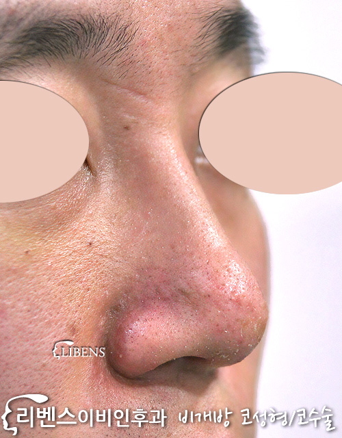 여드름 피부염 콧대 코끝 수술 실리콘 비중격연골 성형 s198