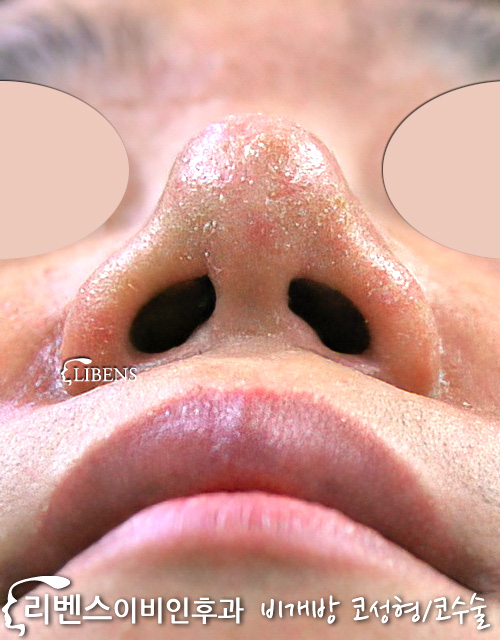 여드름 피부염 콧대 코끝 수술 실리콘 비중격연골 성형 s198