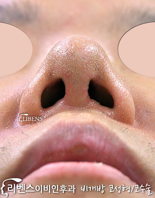 콧대 코끝 수술 남자 실리콘 비중격연골 사용 코끝 연골묶기 재배치 성형 s227