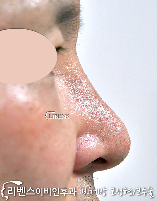 콧구멍 비대칭 교정 처진 코끝 수술 무보형물 코뼈절골 성형 s230