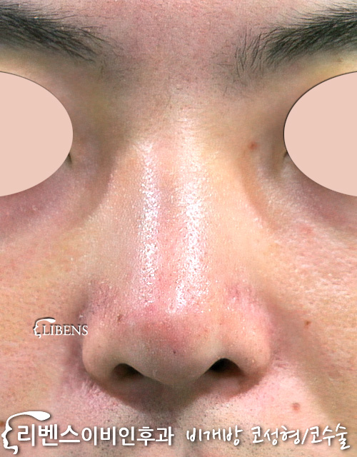 화살코 휜코 처진 코끝 매부리코 교정 수술 무보형물 메부리코 성형 s258