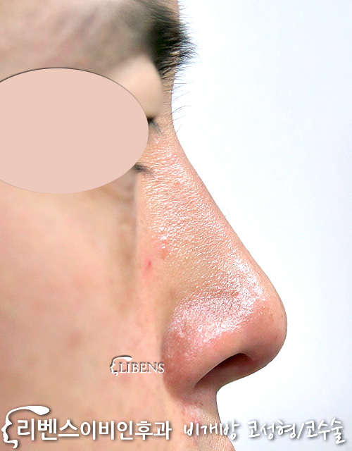 매부리코 메부리코 코끝 높이기 수술 비중격연골 남자 무보형물 성형 s259