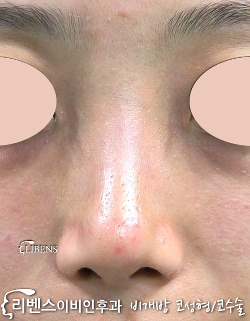 매부리코 메부리코 휜코 코끝 비중격 만곡증 수술 교정 비주 늘이기 연장술 성형 s266