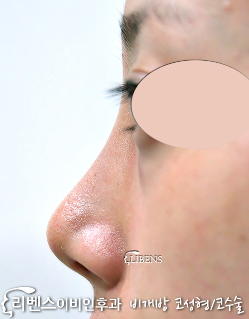 매부리코 메부리코 휜코 코끝 비중격 만곡증 수술 교정 비주 늘이기 연장술 성형 s266