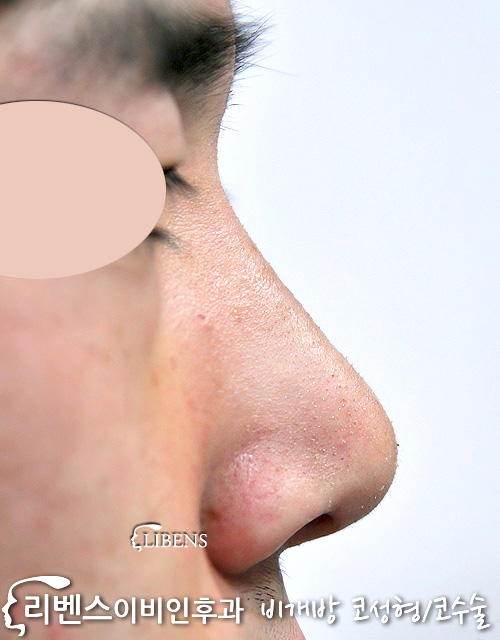 남자 처진 비주 코끝 높이기 매부리코 메부리코 깍기 수술 무보형물 성형 s272