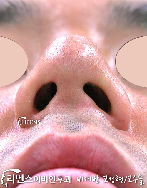 매부리코 메부리코 교정 코끝 콧대 수술 실리콘 비중격연골 성형 s283