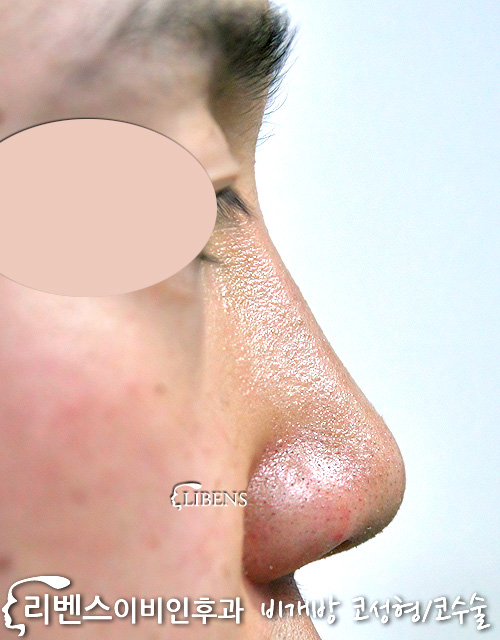 남자 콧대 코끝 복코 수술 높이기 비중격연골 사용 융비술  성형 s289