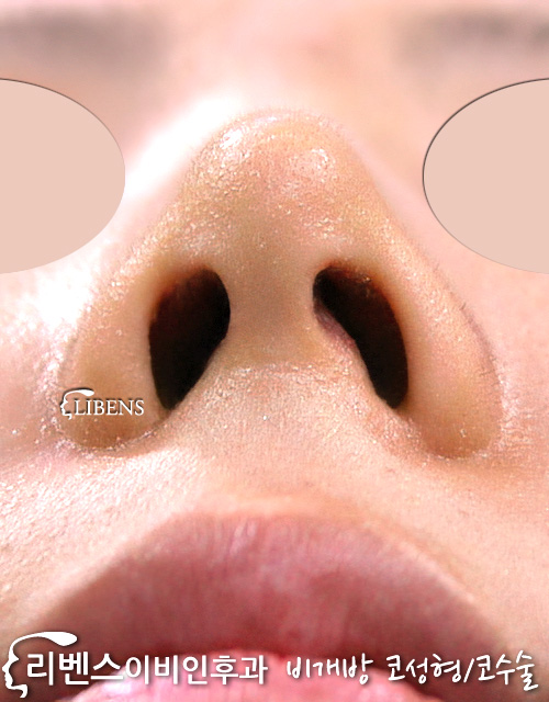 무보형물 매부리 메부리 코수술 코끝 비중격연골 삽입 여자 성형 s326