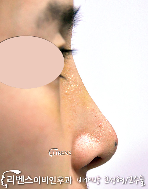 여자 매부리 메부리 코수술 무보형물 코끝 비염 절골 성형 s379