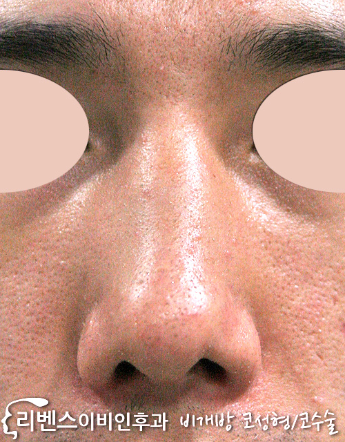 매부리코 메부리코 수술 성형 교정 복코 코끝 절골 무보형물 남자 성형 s384