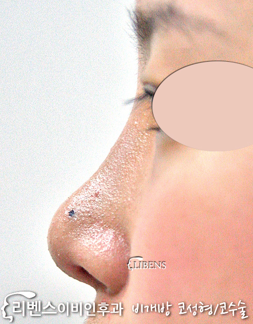 콧대 콧등 성형 수술 실리콘 코끝 연골묶기 비중격 삽입 여자 성형 s386