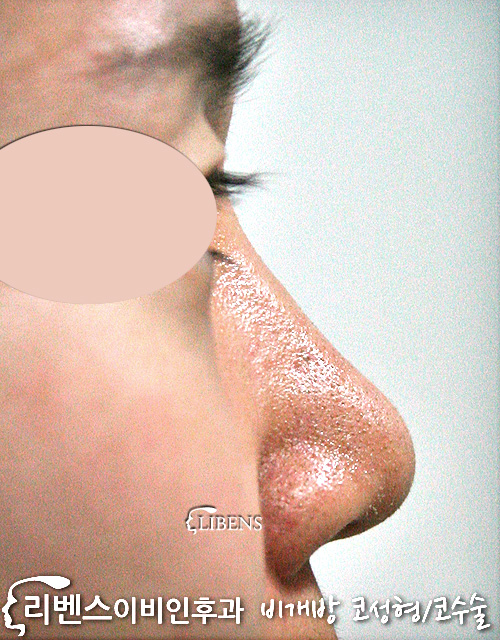 매부리 메부리 코수술 코끝 연골묶기 여자 무보형물 성형 s418