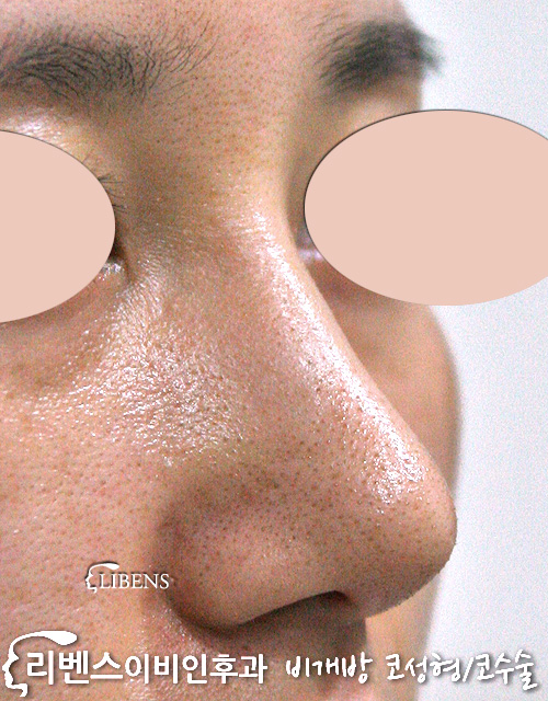 넓은 코뼈 콧등 콧대 매부리코 메부리코 교정 코끝 성형 수술 비개방 무보형물 성형 s420