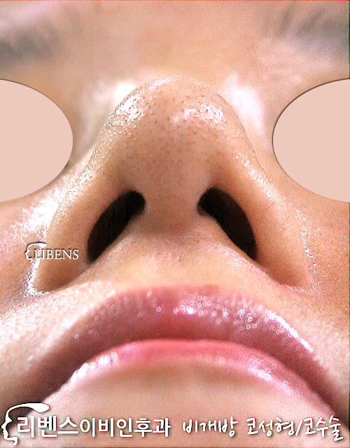 넓은 코뼈 콧등 콧대 매부리코 메부리코 교정 코끝 성형 수술 비개방 무보형물 성형 s420