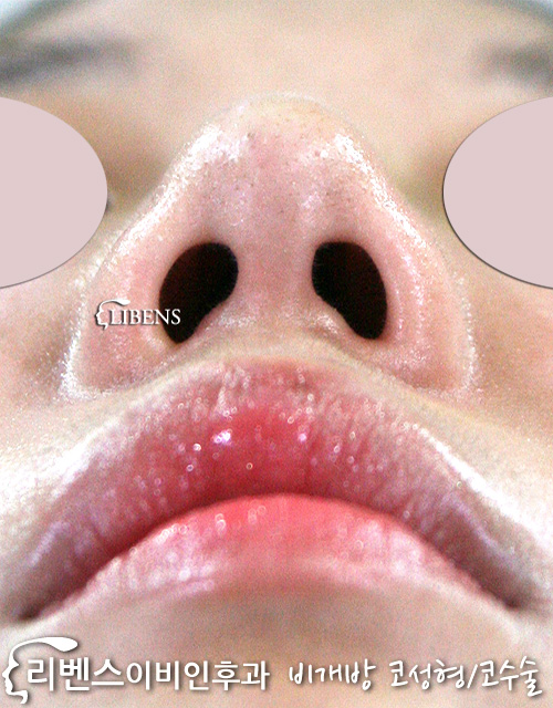 매부리 메부리 코수술 코끝 코뼈 내측 외측 절골 무보형물 성형 s490