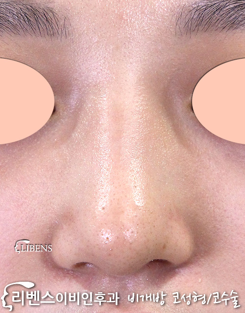매부리코 메부리코 성형 수술 교정 코끝 콧구멍 비대칭 휜코 절골 무보형물 성형 s590