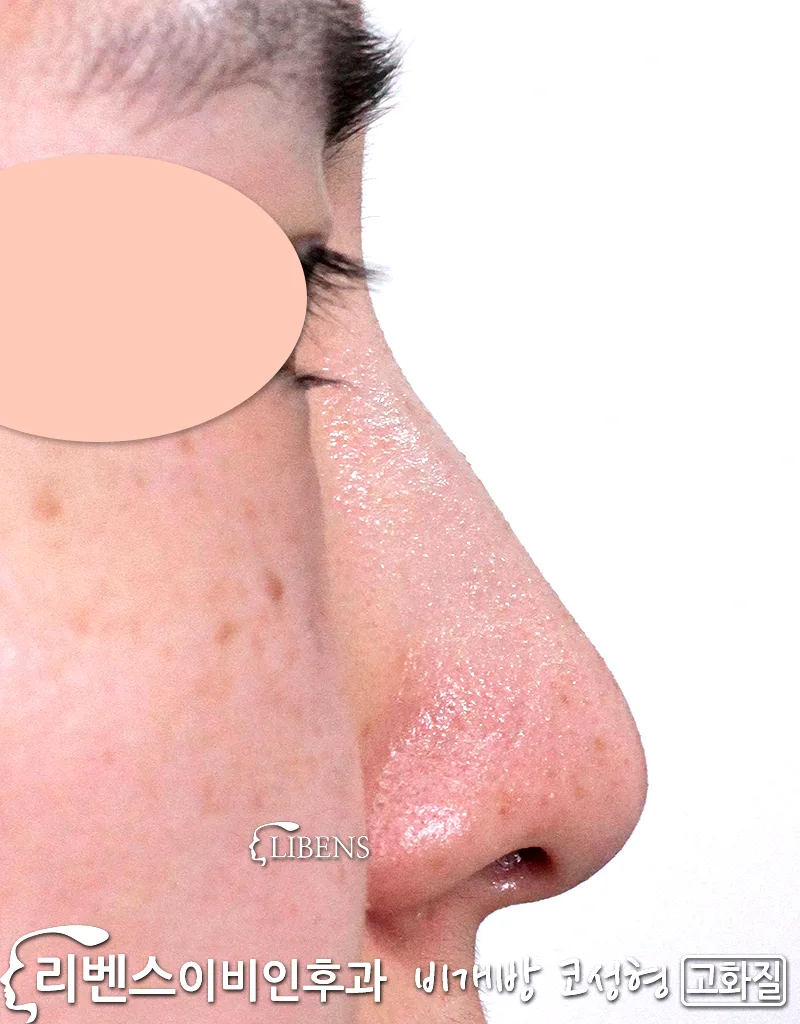 매부리코 메부리코, 처진 낮은 넓은, 코끝 수술 성형 교정 무보형물 성형 s913